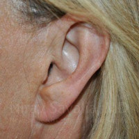 Torn Earlobe Repair Ear Gauge Repair Before & After Gallery - Patient 1655697 - Image 2