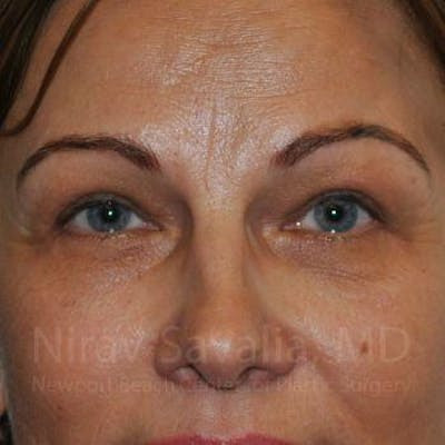 Brow Lift Before & After Gallery - Patient 1655701