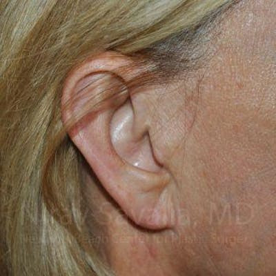 Torn Earlobe Repair Ear Gauge Repair Before & After Gallery - Patient 1655697 - After