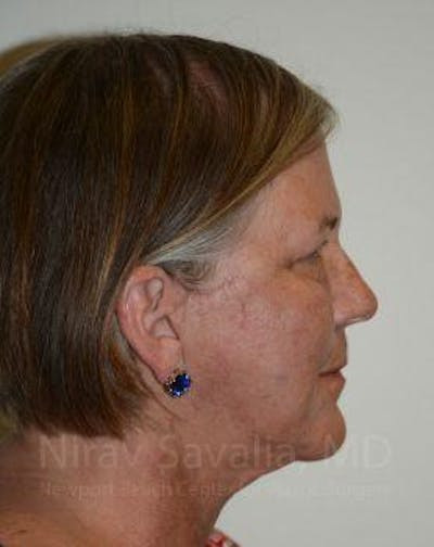 Torn Earlobe Repair Ear Gauge Repair Before & After Gallery - Patient 1655699