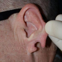 Torn Earlobe Repair Ear Gauge Repair Before & After Gallery - Patient 1655700 - Image 1