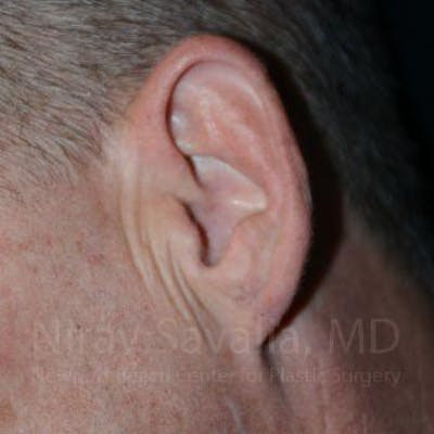 Torn Earlobe Repair Ear Gauge Repair Before & After Gallery - Patient 1655700