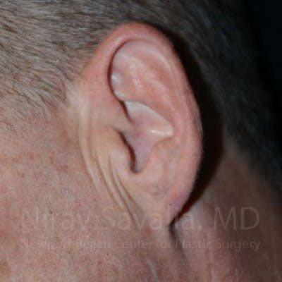 Torn Earlobe Repair Ear Gauge Repair Before & After Gallery - Patient 1655700 - After