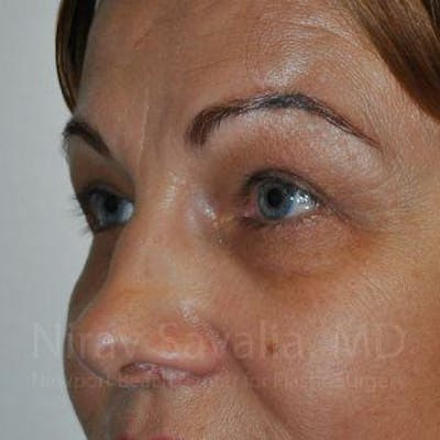 Chin Implants Before & After Gallery - Patient 1655701 - After