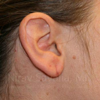 Torn Earlobe Repair Ear Gauge Repair Before & After Gallery - Patient 1655703 - Image 1