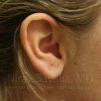 Torn Earlobe Repair Ear Gauge Repair Before & After Gallery - Patient 1655703 - Image 2