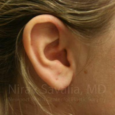 Torn Earlobe Repair Ear Gauge Repair Before & After Gallery - Patient 1655703