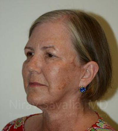 Facelift Before & After Gallery - Patient 1655705 - After