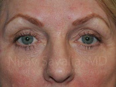 Eyelid Surgery Before & After Gallery - Patient 1655707