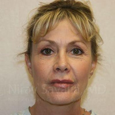 Facelift Before & After Gallery - Patient 1655706