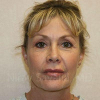 Brow Lift Before & After Gallery - Patient 1655706 - Image 2