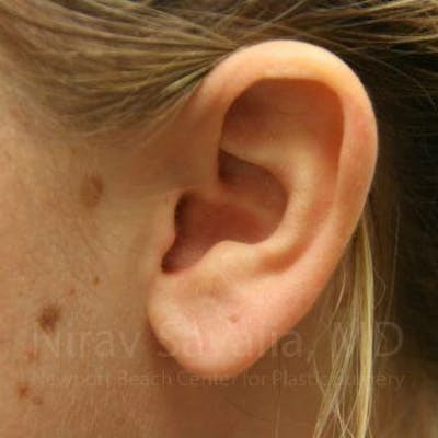 Torn Earlobe Repair Ear Gauge Repair Before & After Gallery - Patient 1655703 - After