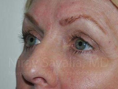 Facelift Before & After Gallery - Patient 1655707 - After