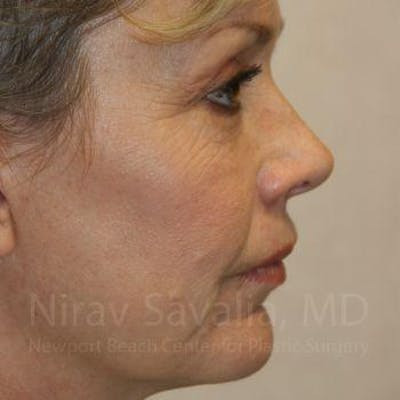 Facelift Before & After Gallery - Patient 1655706 - After