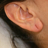 Torn Earlobe Repair Ear Gauge Repair Before & After Gallery - Patient 1655708 - Image 1