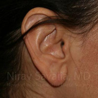 Torn Earlobe Repair Ear Gauge Repair Before & After Gallery - Patient 1655708 - Image 2