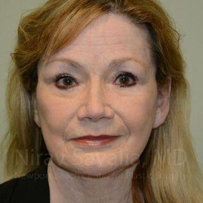 Chin Implants Before & After Gallery - Patient 1655710
