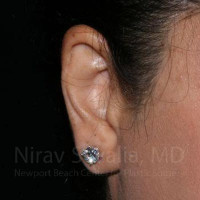 Torn Earlobe Repair Ear Gauge Repair Before & After Gallery - Patient 1655709 - Image 2