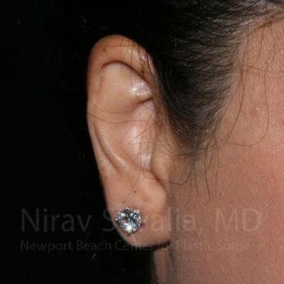 Torn Earlobe Repair Ear Gauge Repair Before & After Gallery - Patient 1655709