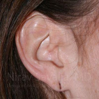 Torn Earlobe Repair Ear Gauge Repair Before & After Gallery - Patient 1655713 - Image 1