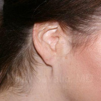 Torn Earlobe Repair Ear Gauge Repair Before & After Gallery - Patient 1655713 - Image 2