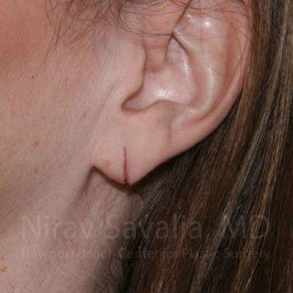 Torn Earlobe Repair Ear Gauge Repair Before & After Gallery - Patient 1655713 - Before