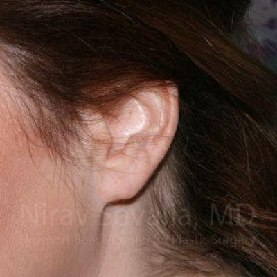 Torn Earlobe Repair Ear Gauge Repair Before & After Gallery - Patient 1655713 - After