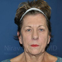 Fat Grafting to Face Before & After Gallery - Patient 1655716 - Image 1