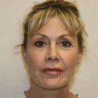 Eyelid Surgery Before & After Gallery - Patient 1655714 - Image 2