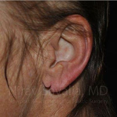Torn Earlobe Repair Ear Gauge Repair Before & After Gallery - Patient 1655715 - Before