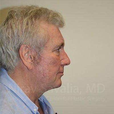 Oncoplastic Reconstruction Before & After Gallery - Patient 1655717