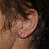 Torn Earlobe Repair Ear Gauge Repair Before & After Gallery - Patient 1655715 - Image 2