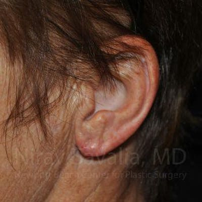 Torn Earlobe Repair Ear Gauge Repair Before & After Gallery - Patient 1655715