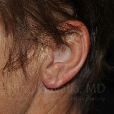 Oncoplastic Reconstruction Before & After Gallery - Patient 1655715 - After