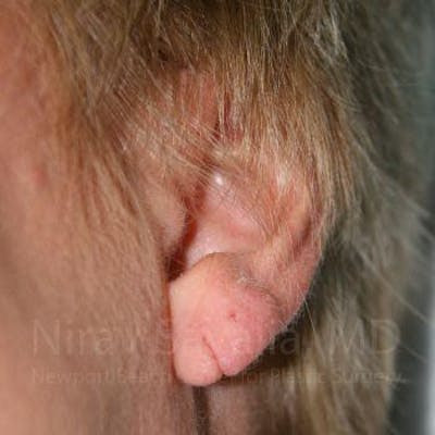 Torn Earlobe Repair Ear Gauge Repair Before & After Gallery - Patient 1655718 - Before