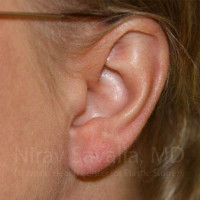 Torn Earlobe Repair Ear Gauge Repair Before & After Gallery - Patient 1655718 - Image 2
