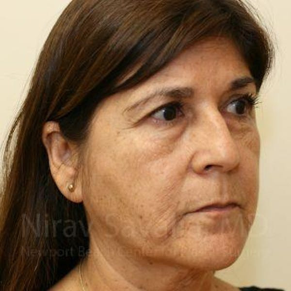 Facelift Before & After Gallery - Patient 1655721 - Before