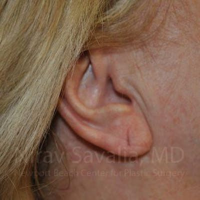 Torn Earlobe Repair Ear Gauge Repair Before & After Gallery - Patient 1655722 - Before