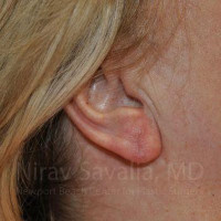 Torn Earlobe Repair Ear Gauge Repair Before & After Gallery - Patient 1655722 - Image 2
