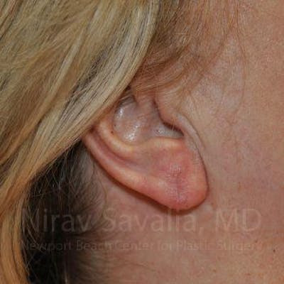 Torn Earlobe Repair Ear Gauge Repair Before & After Gallery - Patient 1655722