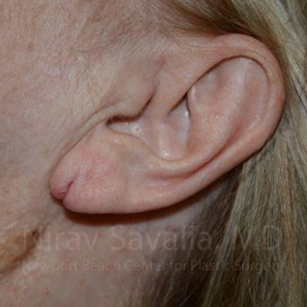 Torn Earlobe Repair Ear Gauge Repair Before & After Gallery - Patient 1655722 - Before