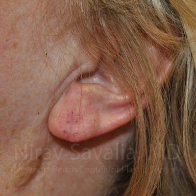 Torn Earlobe Repair Ear Gauge Repair Before & After Gallery - Patient 1655722 - After