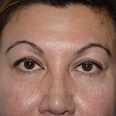 Eyelid Surgery Before & After Gallery - Patient 1655728 - Before