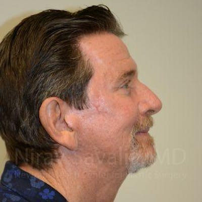 Torn Earlobe Repair Ear Gauge Repair Before & After Gallery - Patient 1655726