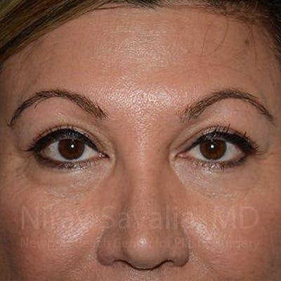 Facelift Before & After Gallery - Patient 1655728 - After