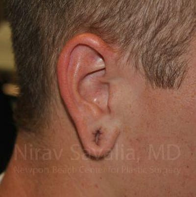 Torn Earlobe Repair Ear Gauge Repair Before & After Gallery - Patient 1655727 - Before