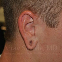 Torn Earlobe Repair Ear Gauge Repair Before & After Gallery - Patient 1655727 - Image 1