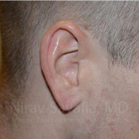 Torn Earlobe Repair Ear Gauge Repair Before & After Gallery - Patient 1655727 - Image 2