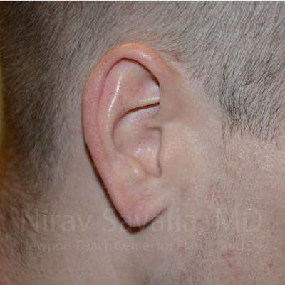 Torn Earlobe Repair Ear Gauge Repair Before & After Gallery - Patient 1655727