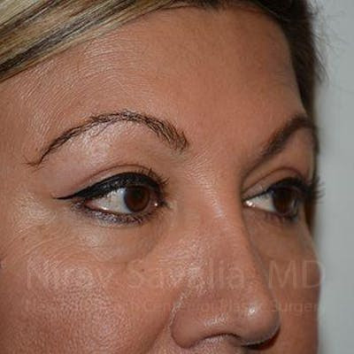 Brow Lift Before & After Gallery - Patient 1655728 - After